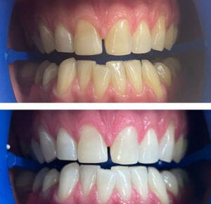 Teeth Whitening