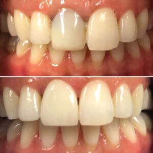 porcelain veneers