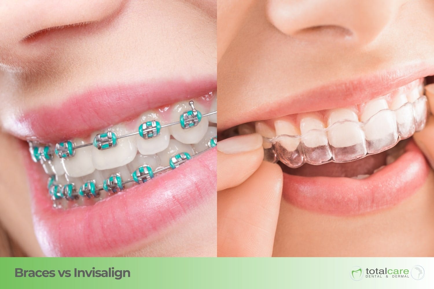 braces vs invisalign