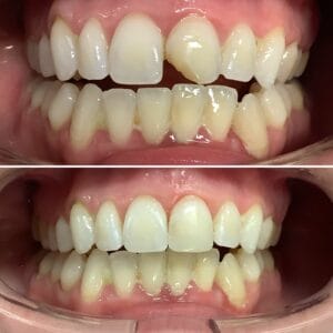 composite bonding