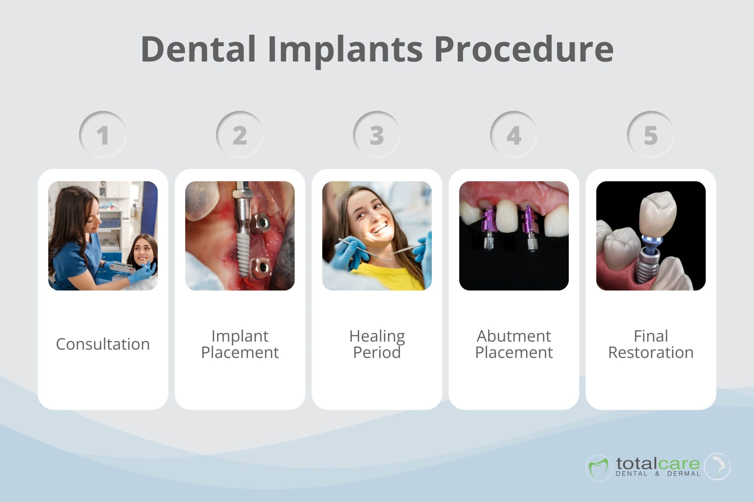 dental implants procedure dental implants procedure