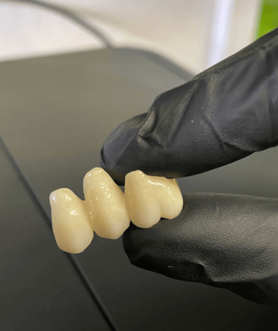 how to choose the right dentist for your wisdom teeth removal in sydney