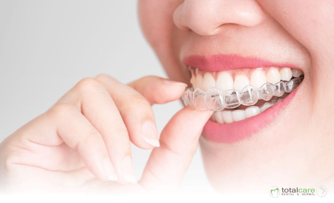 invisalign maintenance