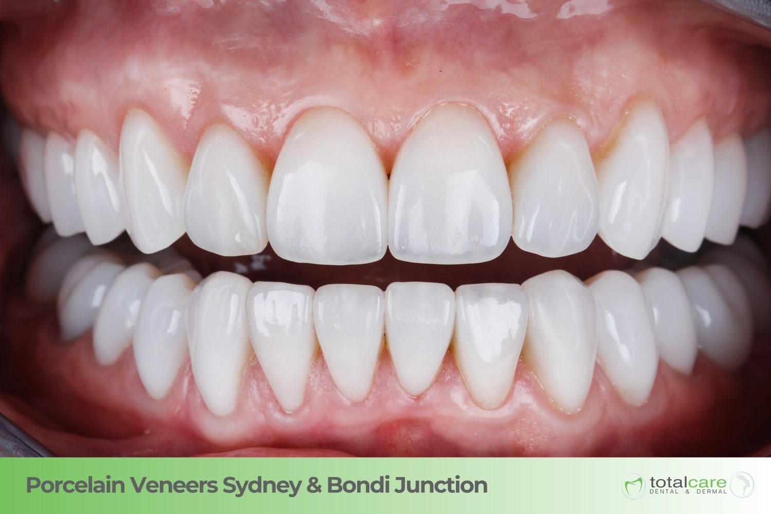 porcelain veneers sydney & bondi junction porcelain veneers sydney & bondi junction