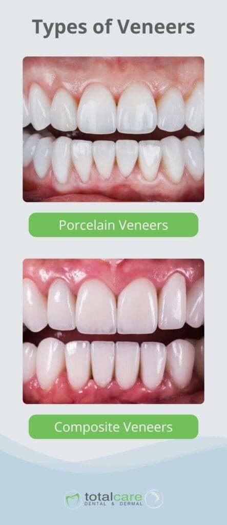 Types of dental veneers