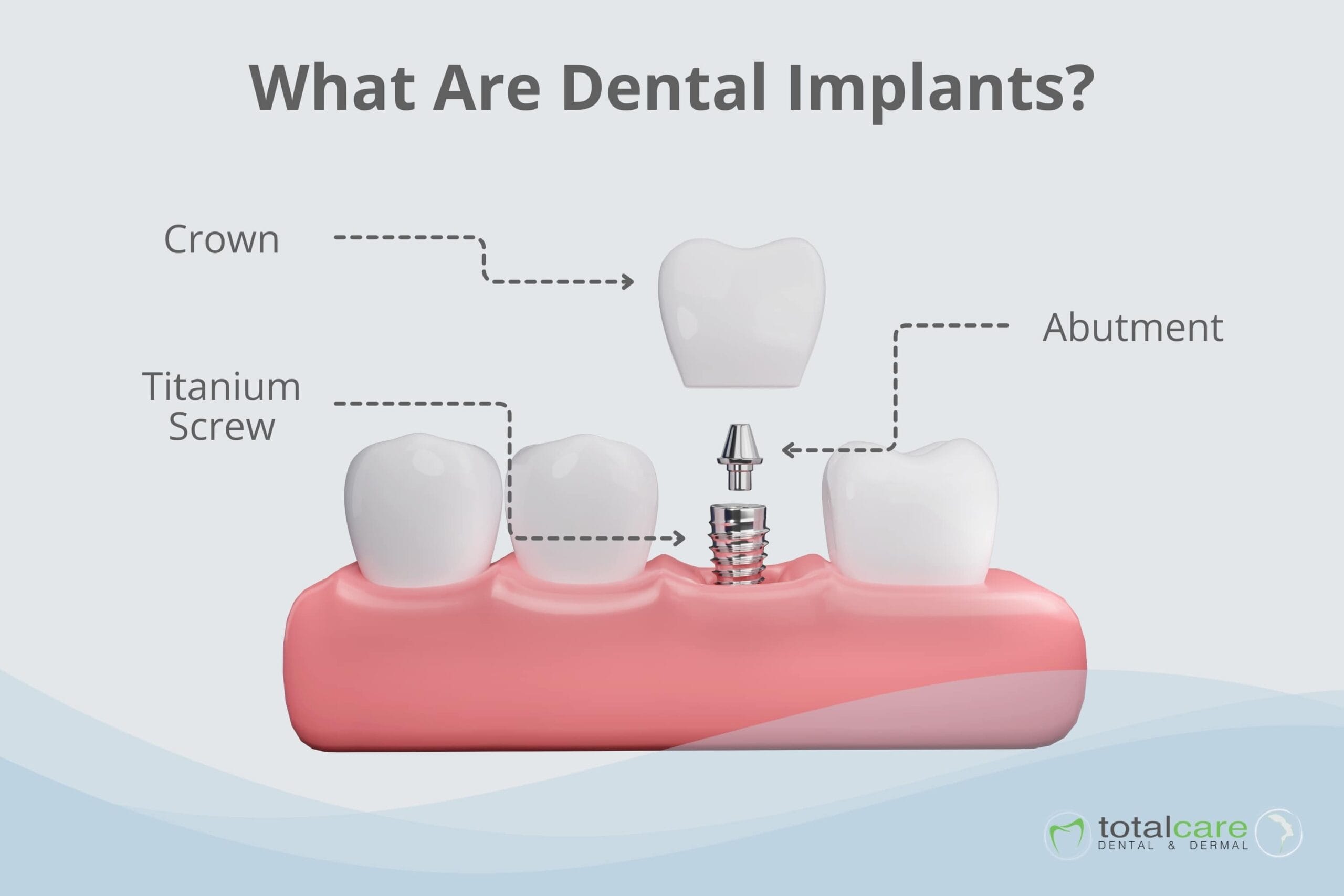 What are Dental Implants & its Components? What are Dental Implants & its Components?