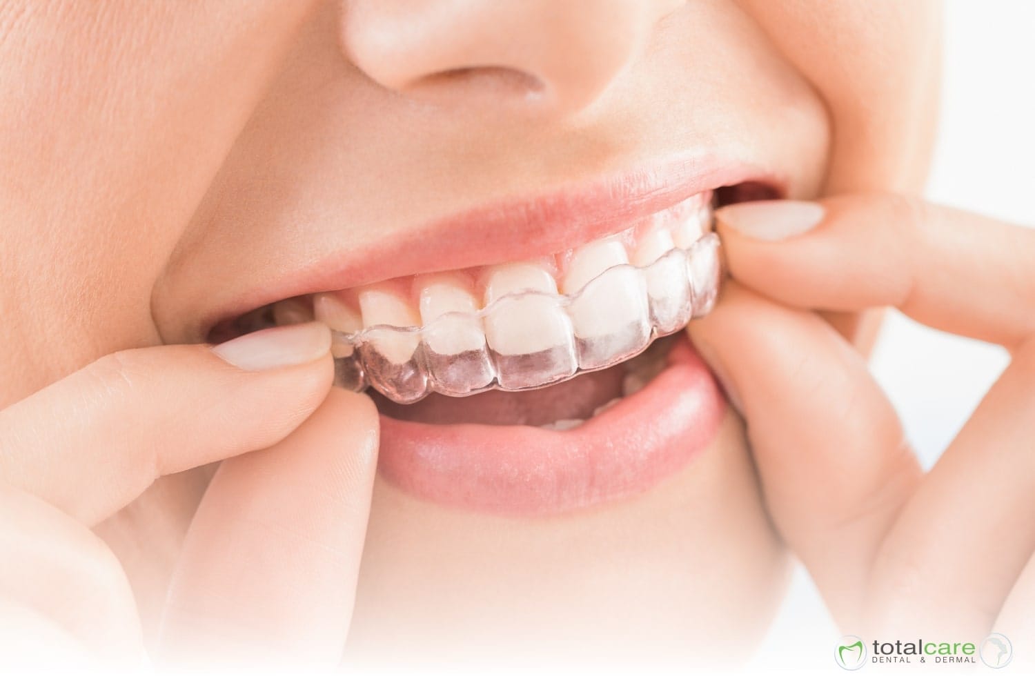 What is Invisalign? What is Invisalign?